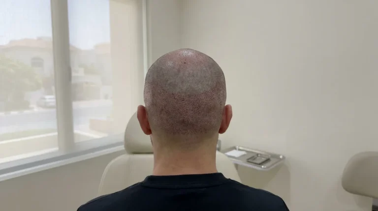 How to Take Care After Hair Transplant Surgery in Dubai’s Heat