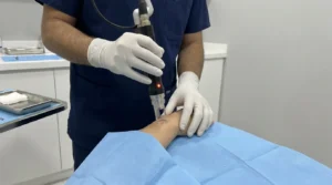 stretch mark removal: gloved clinician guiding a fractional laser handpiece over a draped forearm in a Dubai clinic room